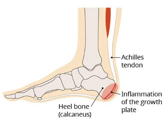 Musculoskeletal presentations (chronic) in babies and children ...